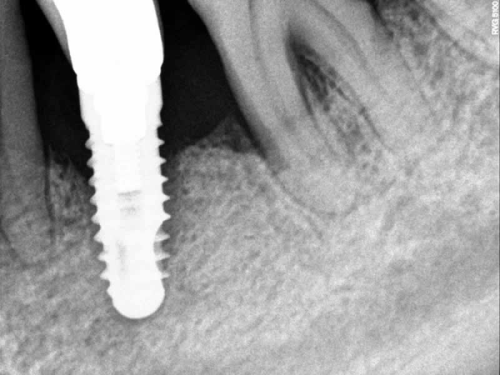 radiografia-perimplantite-2